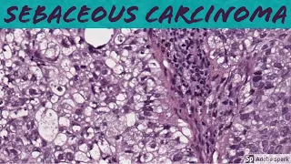 Sebaceous Carcinoma: 5-Minute Pathology Pearls