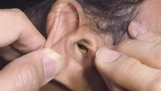 Dry Earwax Removal & Ear Cleaning using Cotton Tipped Applicator