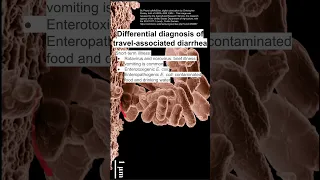 Differential diagnosis of travel-associated diarrhea