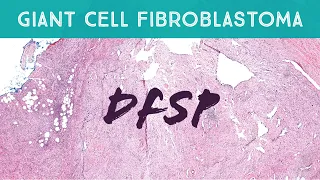 Dermatofibrosarcoma protuberans with giant cell fibroblastoma pattern (GCF-DFSP) pathology dermpath