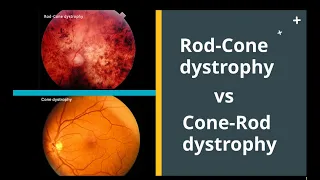Rod Cone dystrophy VS Cone Rod dystrophy