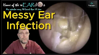 Messy Ear Infection 215 #ear #earwax #earwaxremoval #earcleaning #asmr #asmrearwax #infection
