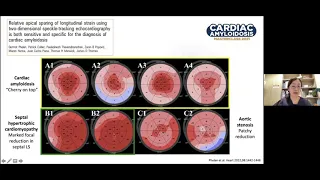 Echocardiography in Cardiac Amyloidosis