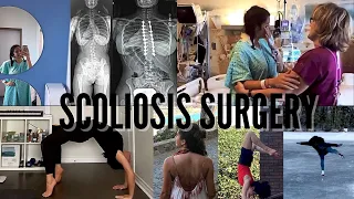 Scoliosis Surgery (3 years post-op)