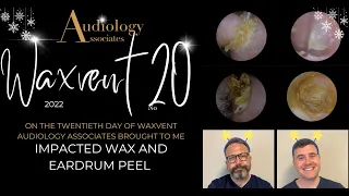 IMPACTED WAX AND EARDRUM PEEL - EP705