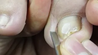 Manicure Teach: deep ingrown nail fixing