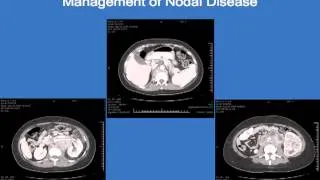 Outcomes for patients with locally advanced renal cell carcinoma Christopher G. Wood, M.D., UT