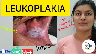 LEUKOPLAKIA - PREMALIGNANT LESION