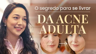 Como ACABAR COM A ACNE na mulher adulta | Com Dra. Marina Hayashida