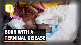 Parents Wish Death For Baby Born With a Rare Ailment | The Quint