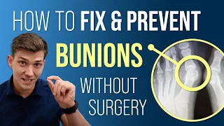 How to Fix & Prevent Bunions Without Surgery!