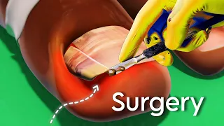 Ingrown Toenail Surgery ( 3D Animation )