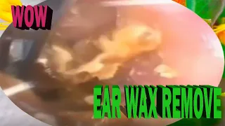 Ear Wax. Deep Impacted Hard Stuck Ear Wax Removal & Cleaning Sap#124