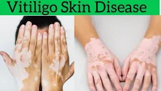 Vitiligo, Causes, Symptoms, Diagnose, Treatment for Vitiligo in Hindi/Urdu. | skin patches|