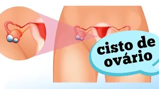 COMO IDENTIFICAR UM CISTO DE OVÁRIO?