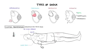 Approach to Shock - types, hypovolemic, cardiogenic, distributive, anaphylaxis, pathology, treatment