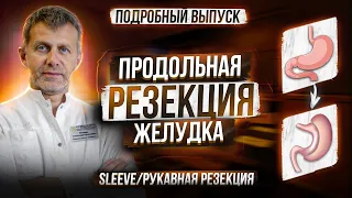 ПРОДОЛЬНАЯ РЕЗЕКЦИЯ ЖЕЛУДКА • SLEEVE • СЛИВ • РУКАВНАЯ РЕЗЕКЦИЯ • схема операции, технические нюансы