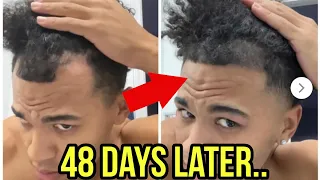 He REVERSED Hair Loss in 48 Days DOING THIS!