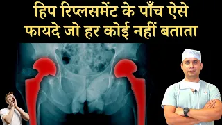 (five advantages of hip replacement)  /कुल्हा बदलवाने के 5 फायदे जो कोई नहीं बताता हिंदी में