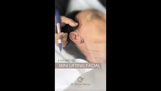 Cicatriz do Mini Lifting Facial fica onde? |Dr. Bruno Nunes siga no Instagram @plastica_facil