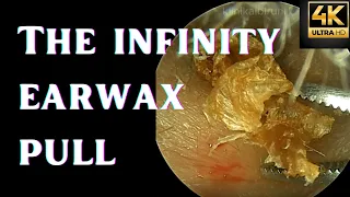 Infinity Earwax Pull (4k 60 fps)