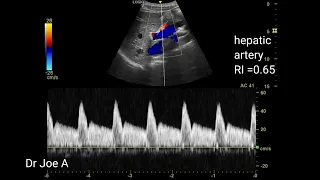 Doppler ultrasound video normal liver: portal vein, hepatic vein and artery. portal hypertension