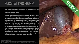 Laparoscopic Cholecystectomy for Symptomatic Cholelithiasis - Standard (Feat. Dr. Brunt)