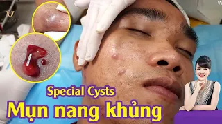 Extract some Special Cysts at hien van spa | Điều trị mụn nang hiệu quả TPHCM | Trọng Hữu | 583