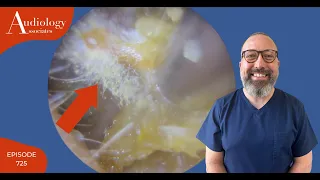 FUNGAL EAR INFECTION (OTOMYCOSIS) REMOVAL - EP725