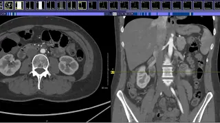 How to read an Aortic Runoff