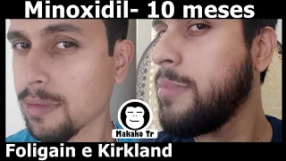 Minoxidil Foligain e Kirkland 5% - 10 meses de uso -Meu Resultado Final Valem a pena?  [barba]