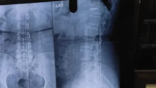 How To Read LS Spine X Ray ? Dr Sai Chandra MBBS DNB (Ortho)