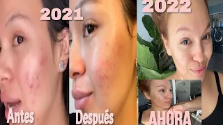 clear skin! No more acne | TCA Chemical peel at home DIY:experience  total of 8 days.🔥