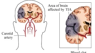 Transient Ischemic Attack (TIA)