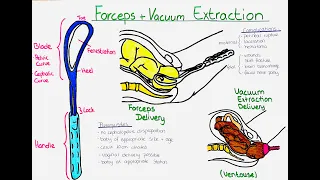 Forceps vs Vacuum Extraction Delivery (Ventouse): Understanding the Difference, Procedures and Risks