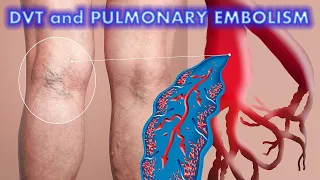 DVT and Pulmonary Embolism (Updated 2022) - CRASH! Medical Review Series