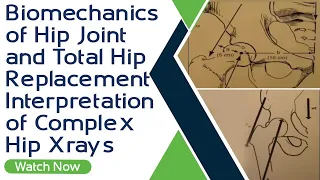 Biomechanics of Hip Joint and Total Hip Replacement | Interpretation of Complex Hip Xrays