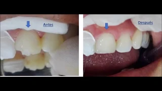 Restauración borde incisal mesial y palatino de diente 21