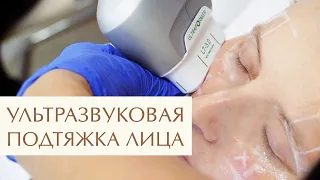 🔥 Что такое ультраформер, как проходит HIFU SMAS лифтинг, отзыв пациента. Что такое ультраформер.12+