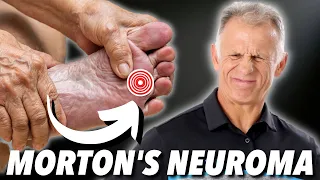 Morton's Neuroma: Absolute Best Treatment (In Our Opinion)