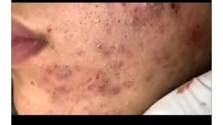 RELAXING PIMPLE POPPING VEDIO WITH LOAN NGUYEN SPA