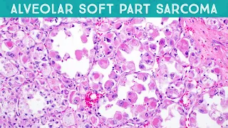 Alveolar soft part sarcoma (explained in 5 minutes): basic soft tissue pathology