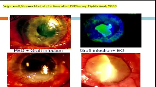 AIOC2018 - GP103 - Topic - Non Resolving Fungal Keratitis Non Resolving Fungal Keratitis