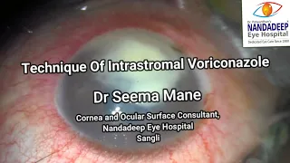 Intrastromal Voriconazole 50 µg0.1ml Dr Seema Mane