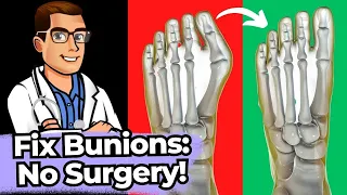 Bunion Home Cure [WOW] Stretches, Exercises & Correctors *NO Surgery*