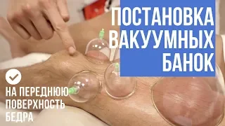 Боли в коленях. Болит поясница. Вакуумный массаж на передней поверхности бедра