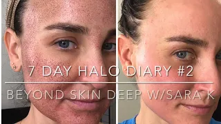 HALO Dairy #2 ⚡️What you need to know about @Sciton Halo treatment BEFORE & AFTER⚡️products tested