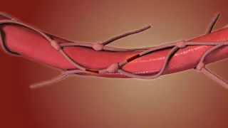 Esophagectomy. Esophagus Removal Animation