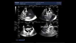 Video shows Hepatic parenchymal disease, Cholecystitis, Pleural effusion, Splenomegaly, and ascites.