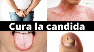 Elimina la candida in modo naturale